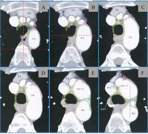 Thoracic Atlas Delineating Lymph Node Stations From The University Of