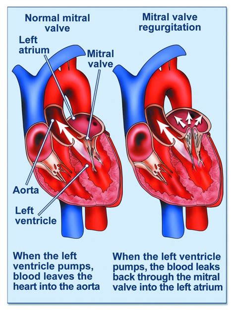 Mitral Regurgitation British Heart Valve Society