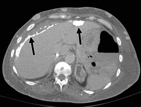 Diagnostic Approach To Benign And Malignant Calcifications In The Abdomen And Pelvis Radiographics