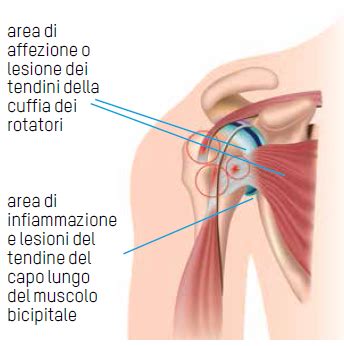 Tendinite Spalla Physiolife Velletri