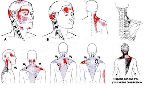 Puntos Gatillo ALTERMEDIC