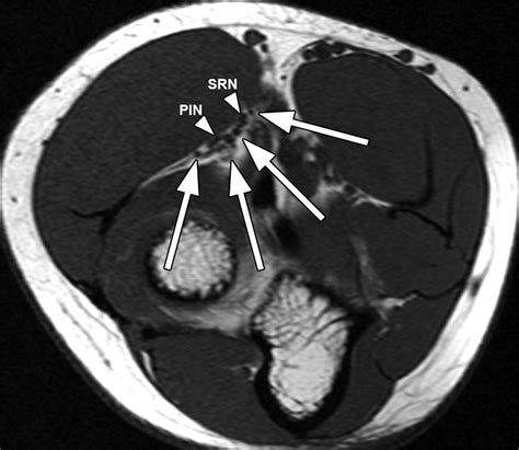 Radial Tunnel Syndrome - Hand - Orthobullets