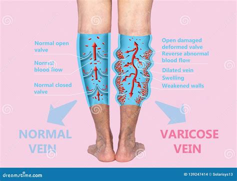 Varicose Veins Rash On Legs