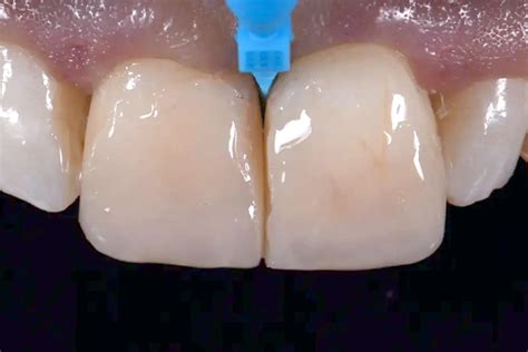Eurasia Dental Elevating Smiles With Fixed Restorations
