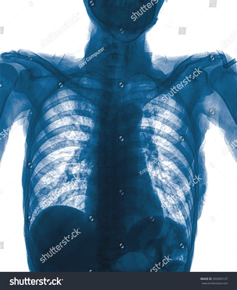 Film Chest Xray Pa Upright Show Stock Photo Shutterstock