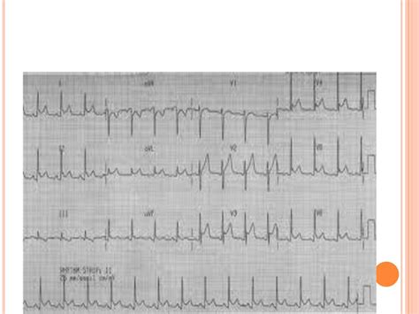 Pericardial Diseases Dr Ghazi F Ppt Download