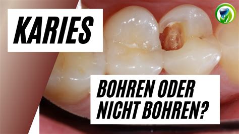 Karies Zahn Bohren Oder Nicht Bohren Abwarten Und Beobachten Das