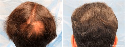 Crown Hair Transplant For Patient Znq Top Scalp Restoration