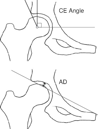 Measures Of Acetabular Depth Ad And Centre Edge Ce Angle The