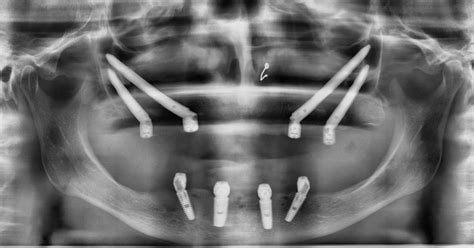 Charge Imm Diate Sur Implant Dentaire Des Dents Provisoires Directement