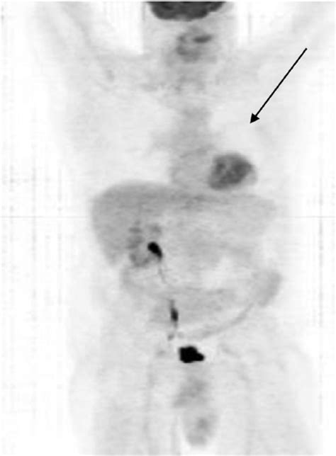 The Long Term Survival Of A Patient With Stage Iv Renal Cell Carcinoma Following An Integrative