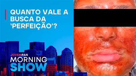 Pol Cia Investiga Morte De Homem Em Sp Ap S Procedimento Peeling De