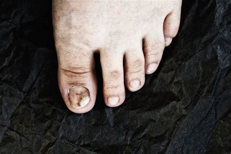 Best Ugly Toenails Stock Photos, Pictures & Royalty-Free Images - iStock