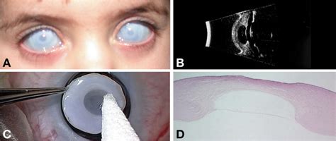 Bilateral Congenital Stromal Cyst Of The Cornea Journal Of American