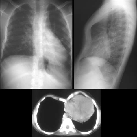 Radiography Chest Pathology Flashcards Quizlet