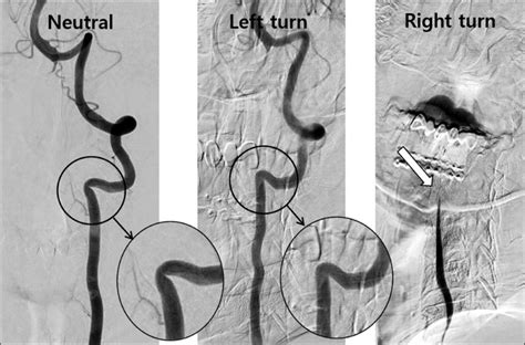 Neutral The Anteroposterior View Of Left Vertebral Artery Va