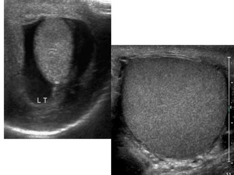 Scrotal Ultrasound Ppt