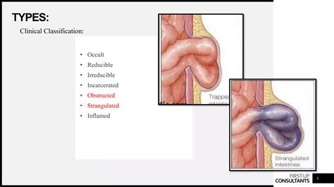 Hernias Definition Types Surgical Anatomy Of Inguinal Hernia Ppt