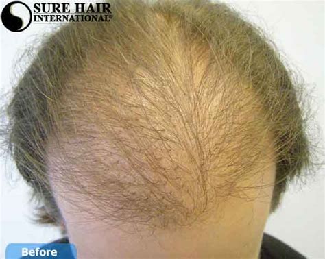 Before And After Hair Transplant Repair Case Sure Hair Transplants Toronto Ontario Canada