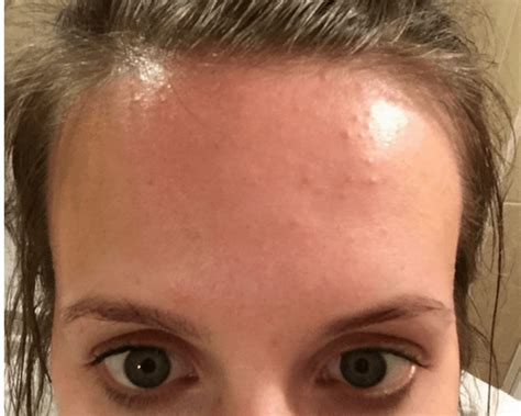 How I Cleared My Tiny Bumps On Forehead Once And For All