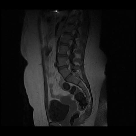 Coccyx Fracture