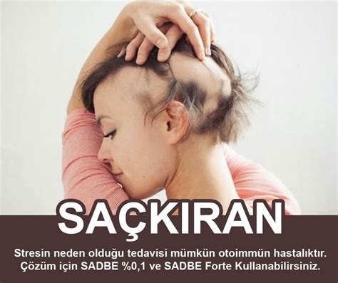 Saç Dökülmesi Nasıl Önlenir on Twitter SAÇKIRAN Alopecia Areata