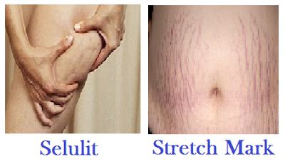 13 Cara Menghilangkan Stretch Mark Secara Alami Dan Medis Pasulukan