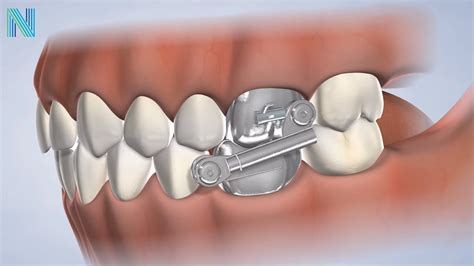 Bite Correction In Fresno Ca Dr Nicole Nalchajian Orthodontics