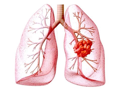 S Ntomas De Una Embolia Pulmonar Mediquo