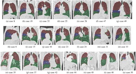 Figure 11 From Automatic Segmentation Of The Pulmonary Lobes From Chest Ct Scans Based On