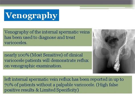 Varicocele Urology Presented By Dr Hassan Sabbagh Urology