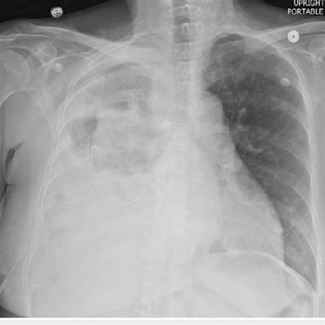 Chest Radiograph 24 Hours Following Initial T Pa And Dnase Download Scientific Diagram