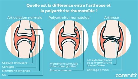 Polyarthrite rhumatoïde et arthrose quelles sont leurs similitudes et