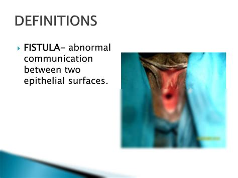 Solution Obstetrics Fistula Ppt Studypool