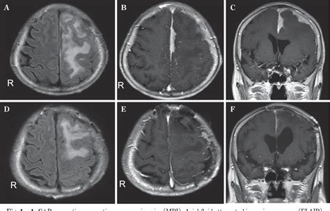 Figure From Isolated Neurosarcoidosis Presenting Similarity To