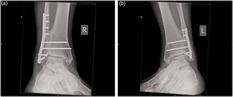 Bilateral Arthrodesis Of The Distal Tibiofibular Joint For Deforming