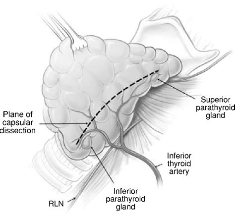 Figure 3 From Total Thyroidectomy The Evolution Of Surgical Technique