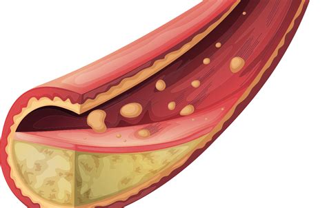 What is Cholesterol? - Canadian Men's Health Foundation