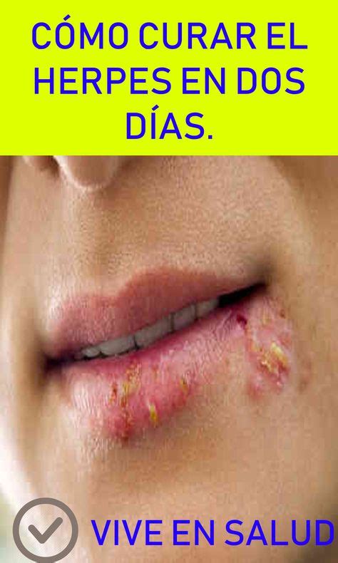 Herpes En La Boca