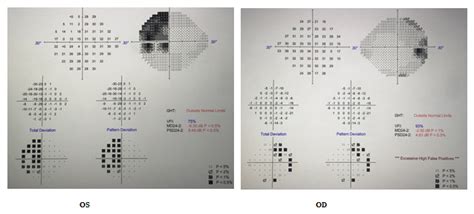 Visual Field Loss due to Cystic Compression of Pituitary Gland Tumor