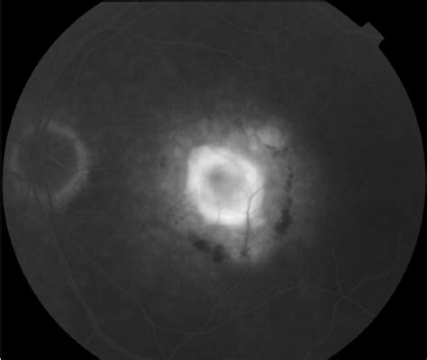 Fundus Fluorescein Angiography Ffa Image Of Corresponding Eye