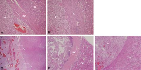 Histologic Analysis Of Peritumoral Pseudocapsules In Partial