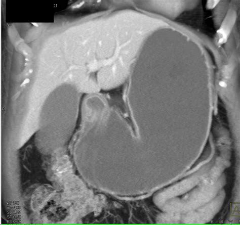 Pancreatic Cancer Encases The Pv Smv And Also Invades The Duodenum