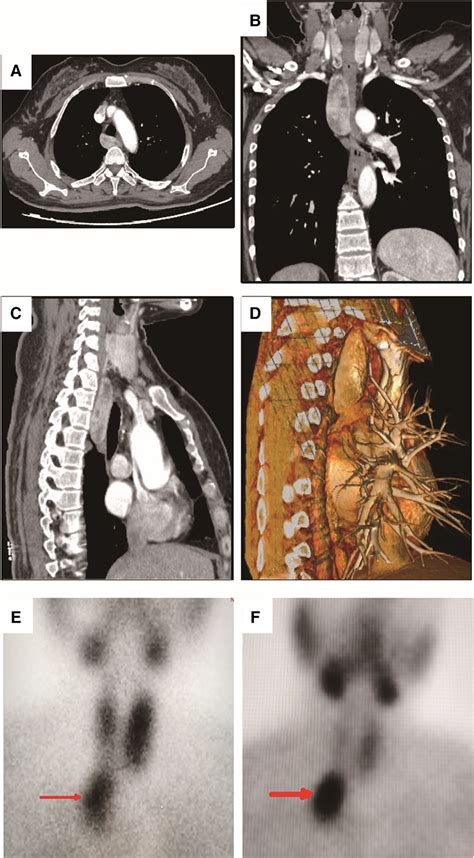 Computed Tomography Ct Scan And M Technetium Sestamibi Scanning Of