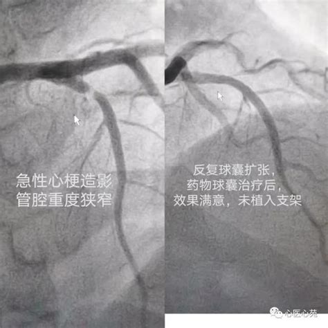 血管內超聲顯神威——優化介入治療，挽救心肌梗死患者生命 每日頭條