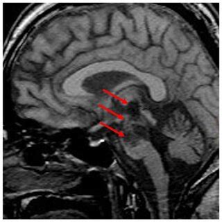 Mri Of A Patient With Locked In Syndrome Due To Basilar Thrombosis