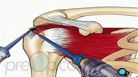 Rotator Cuff Repair Arthroscopic Surgery PreOp Patient Education