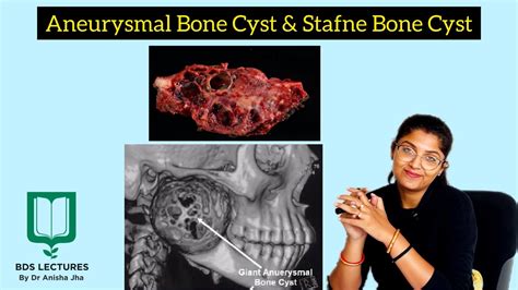 Aneurysmal Bone Cyst Stafne Bone Cyst Lecture 18 Oral Pathology