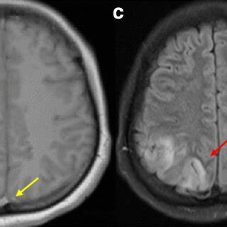 A Year Old Woman Presented With Headache Vomiting And Seizures For