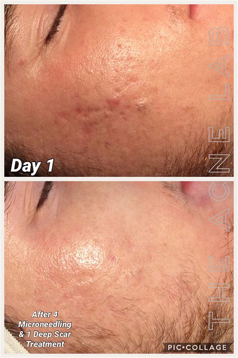 Acne Scars And Hyperpigmentation — The Acne Lab